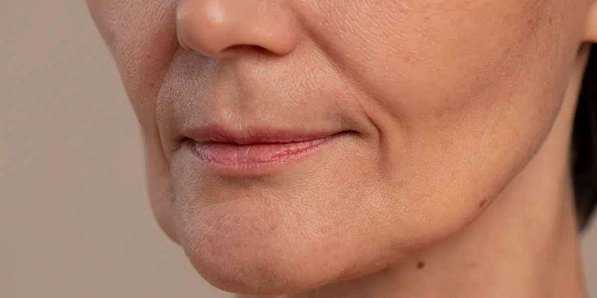 Endolift Alicante para flacidez facial