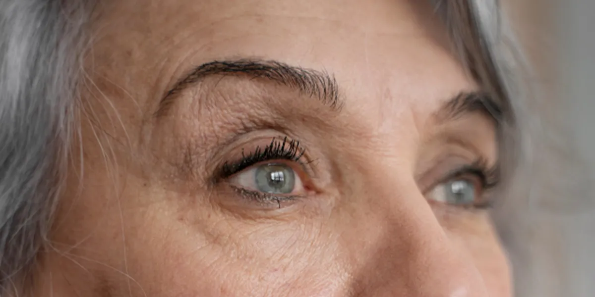 Botox en entrecejo en Alicante para eliminar líneas de expresión y suavizar la mirada