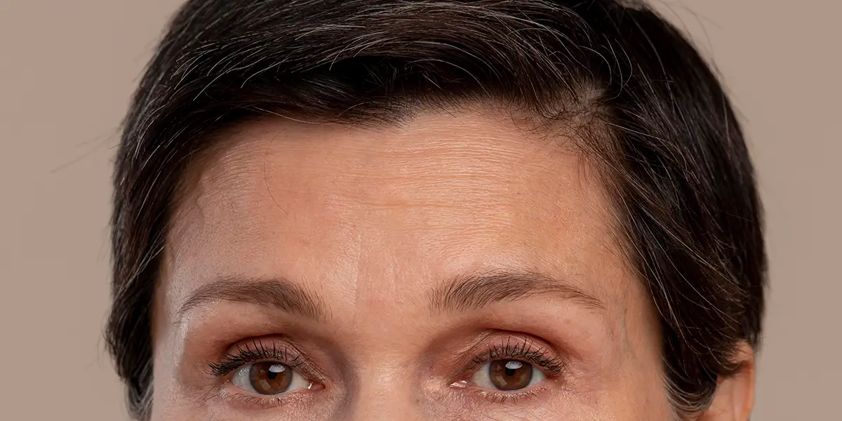 Botox en la frente en Alicante para suavizar arrugas de expresión en Gutiérrez Clinic
