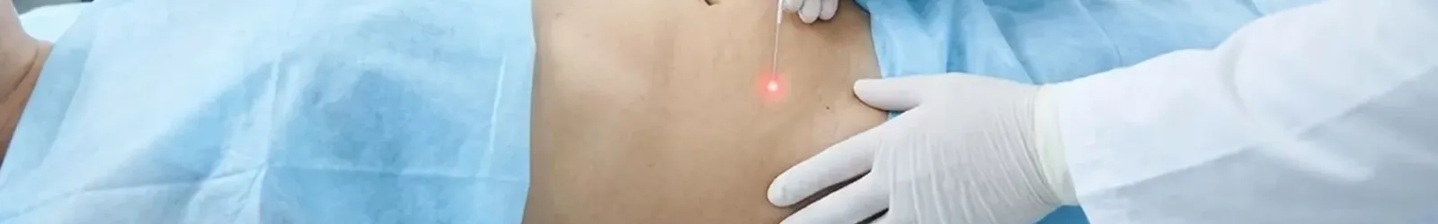 Endolift corporal en Alicante para eliminar grasa localizada y reafirmar el abdomen sin cirugía