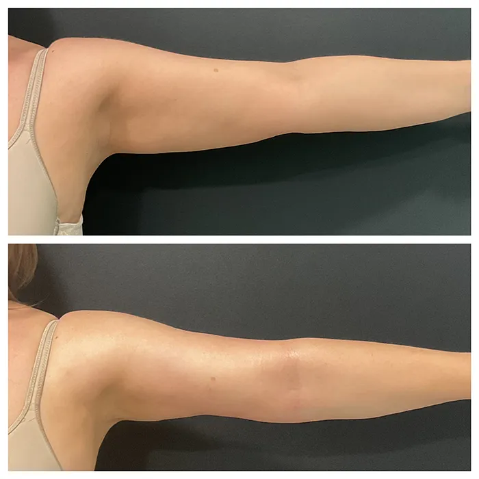 Endolift corporal antes y después