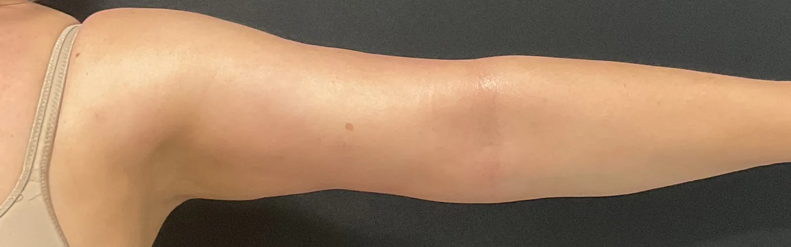 Resultado de Endolift corporal en brazos para mejorar flacidez y reafirmar la piel sin cirugía