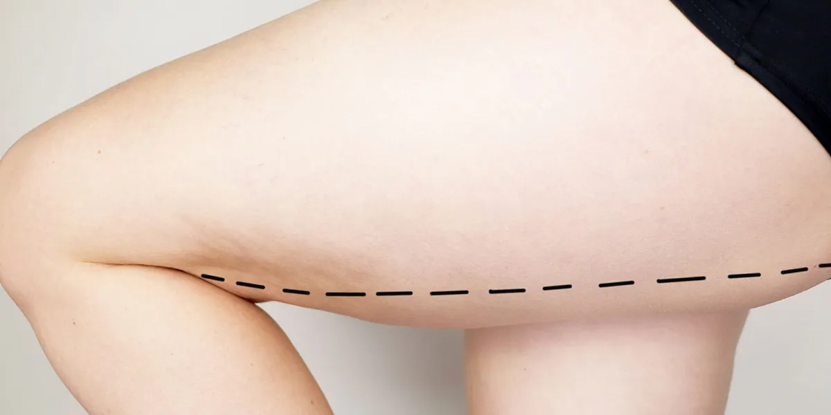 Endolift corporal en muslos para tratar flacidez y reafirmar la piel sin cirugía en Alicante