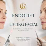 Endolift vs lifting facial en Alicante como alternativa sin cirugía para tratar la flacidez