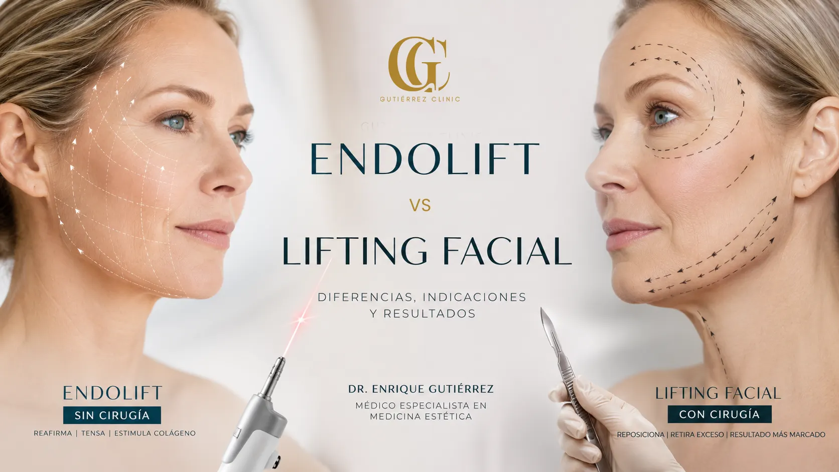 Endolift vs lifting facial en Alicante como alternativa sin cirugía para tratar la flacidez