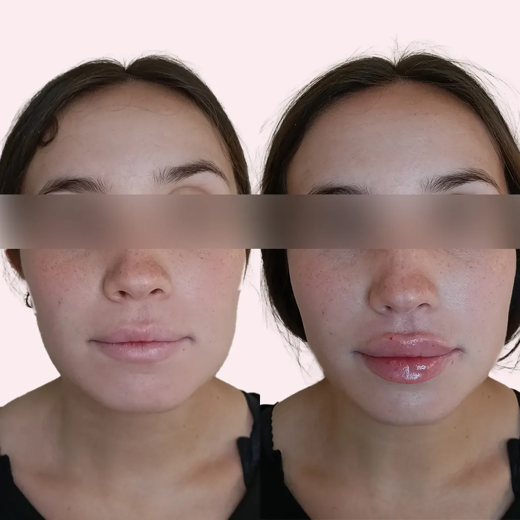 Antes y después de un aumento de labios con ácido hialurónico en Alicante. Resultado natural realizado en Gutiérrez Clinic.