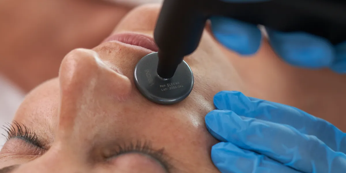 Tratamiento INDIBA facial aplicado en el rostro en Gutiérrez Clinic Alicante