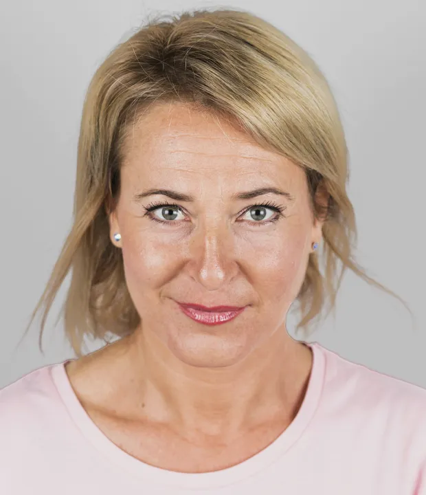 Antes y después de un tratamiento de radiofrecuencia facial en Alicante